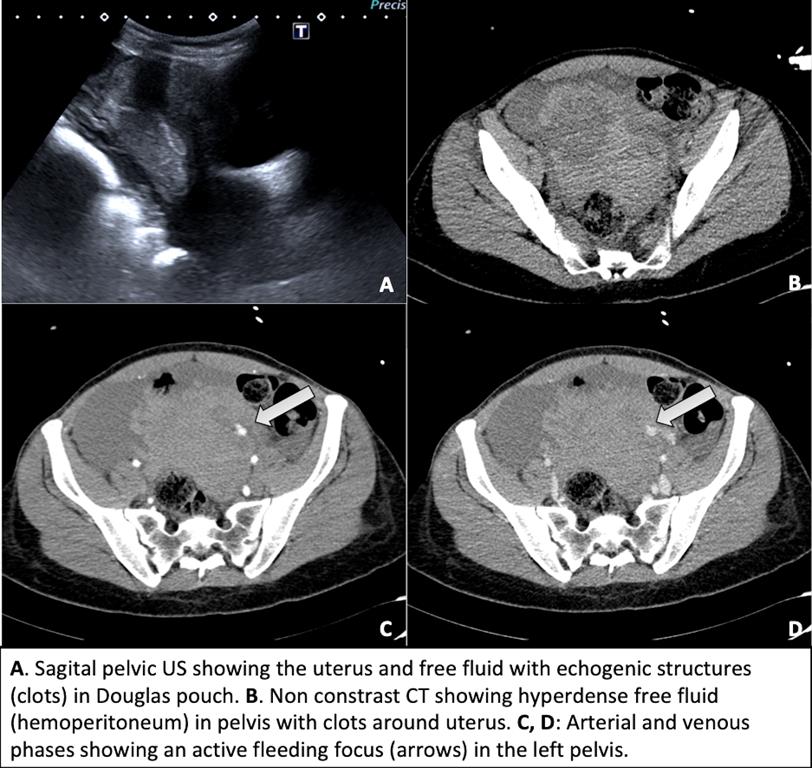 Hemoperitoneum secondary to ruptured ovarian cyst: a tricky diagnosis. –  SERAU. Sociedad Española de Radiología de Urgencias